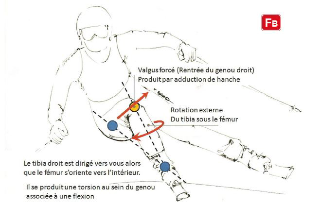 Prévention des ruptures du ligament croisé en ski | EAD